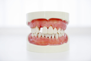 uneven-teeth