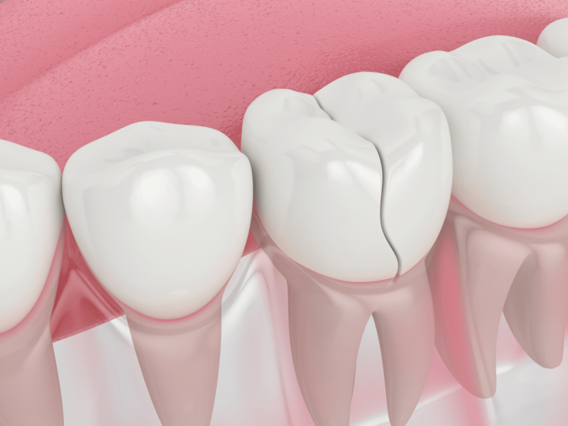 Cracked Tooth Causes, Symptoms, and Treatment - All Smiles Care