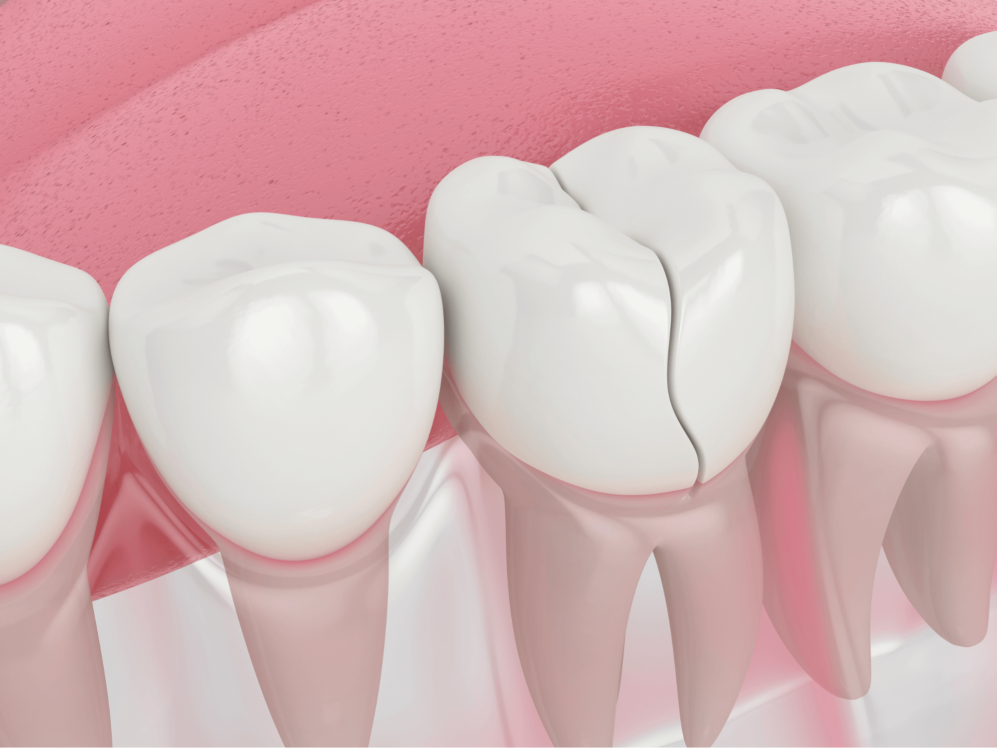 Cracked Tooth Causes, Symptoms, and Treatment All Smiles Care