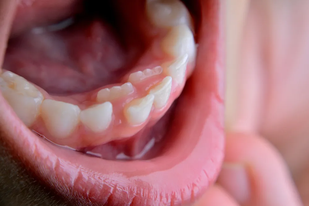 1. A close-up of a person smiling, revealing a gap where a tooth is missing from their mouth.