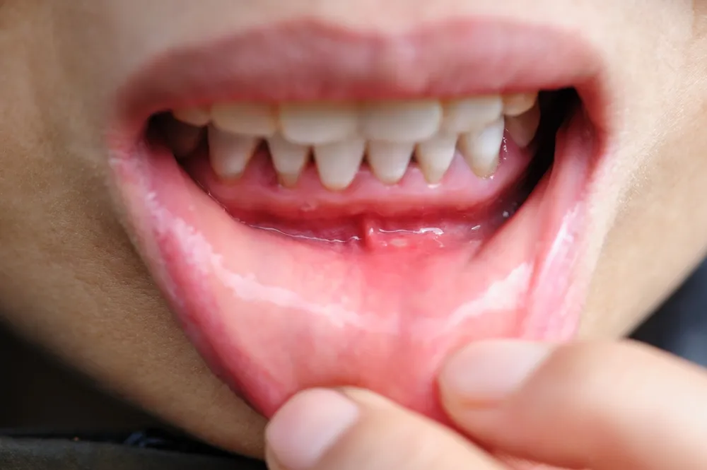 A person showing a tongue covered in blood, indicating a possible injury or trauma.