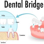 A dental bridge showing crowns, pontic, periodontal ligament, cementum, and jawbone