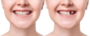 Comparison of a woman's smile before and after dental restoration to fill missing teeth.