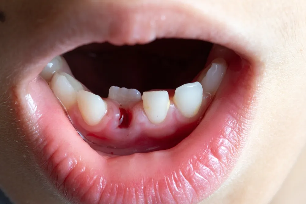 A close-up of a person smiling, showing a noticeable gap where a tooth is missing.